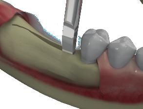 Thin ridged bone should be cut to the depth of implant length.