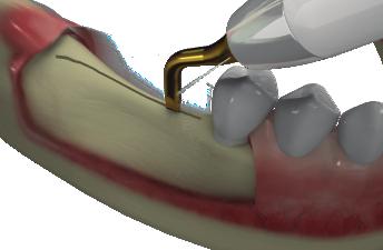 Try to maintain lingual bone thicker than buccal to expand thin ridge buccally Slightly