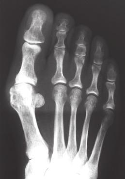 had surgery. Exclusion criteria included substantial degenerative changes of the first metatarsophalangeal joint or the metatarsocuneiform joint. The average age of the patients at surgery was 54.