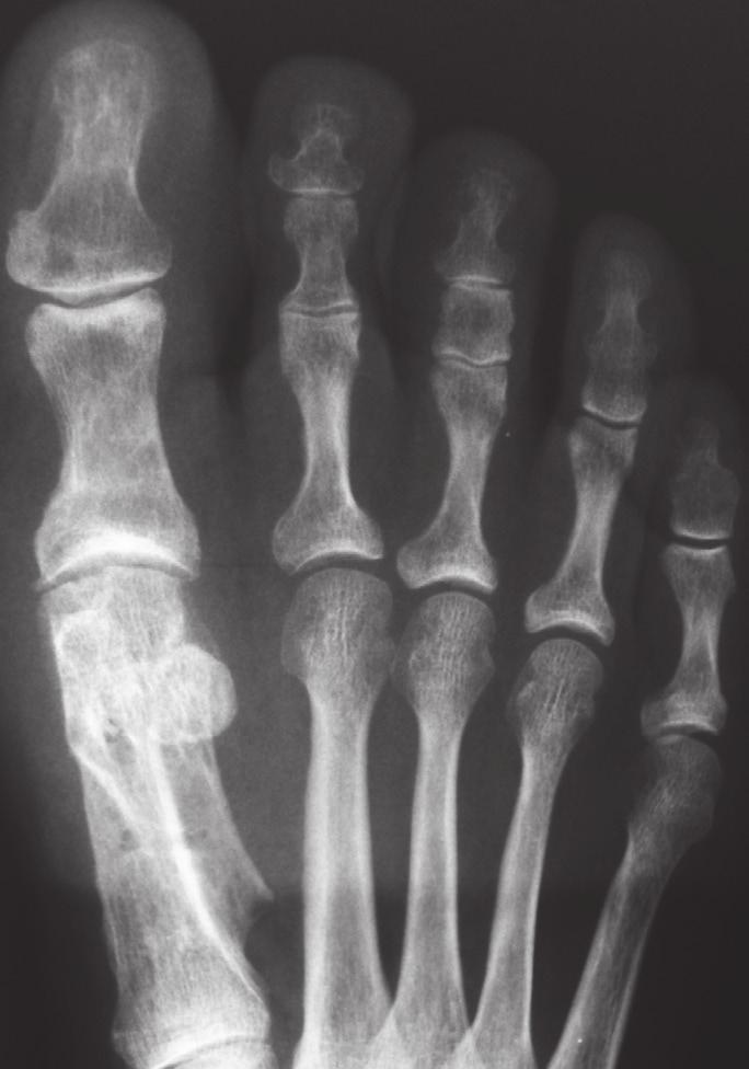 6-mm Kirschner wires. An Akin osteotomy was performed in 30 patients when indicated (the criterion was a hallux interphalangeus).