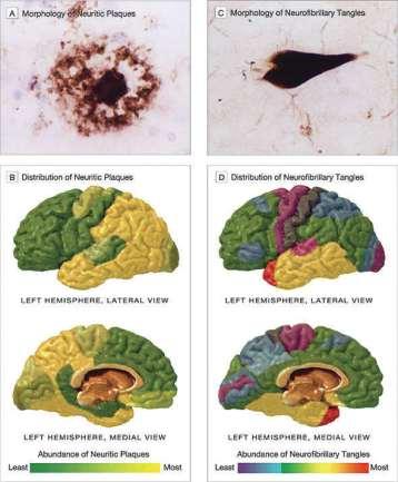 Plaques & Neurofibrillary Tangles