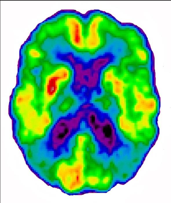 Alzheimer vs Non-Alzheimer Mesial Temporal Atrophy