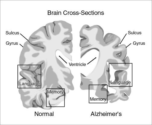 Other factors in Alzheimer s Disease Loss of cholinergi