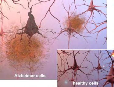 Scientists can also see the terrible effects of Alzheimer's disease when they look at brain tissue under the microscope: Alzheimer's tissue has many fewer nerve cells and synapses than a healthy
