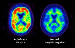 Amyloid Measures Amyloid PET Brain Imaging