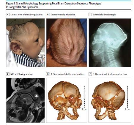 Cranial Morphology Features Severe microcephaly (most more than 3 SD below the mean) Partial collapse of the skull with overlapping sutures Occipital bone prominence Small or absent