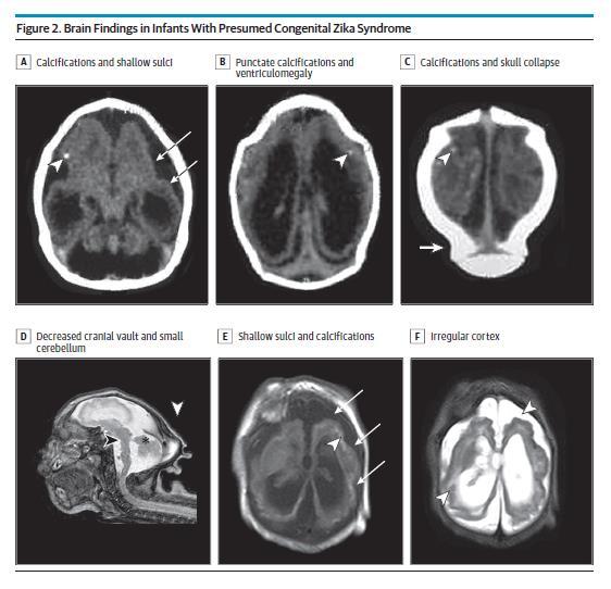 Congenital Zika Syndrome Brain Anomalies Features Intracranial calcifications Cerebral volume loss, ventriculomegaly Abnormal gyral development Low forehead and small