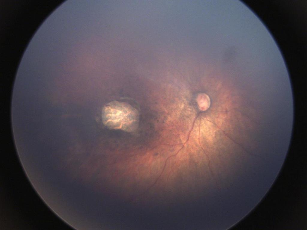 Congenital Zika Syndrome Ocular Findings Structural and anterior eye anomalies» Microphthalmia, coloboma» Cataracts, intraocular calcifications Posterior eye anomalies» Optic nerve hypoplasia,
