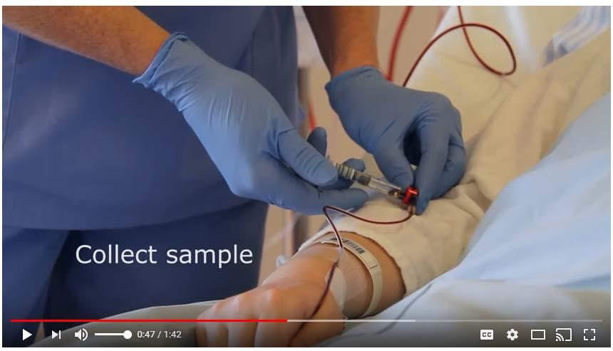How to draw blood sample from an arterial line Click the video link above 1. Use aseptic technique 2. Remove sterile cap from unused port of the most proximal of stopcocks to the insertion site.