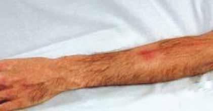 extensive l Pain along the path of the cannula l Erythema l Swelling l Palpable venous cord All of the following are evident & extensive l Pain along the path of the cannula l Erythema l Swelling l