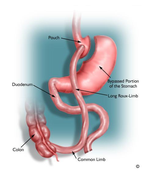 Roux-en-Y gastric bypass Gastric volume reduction & malabsorptive procedure Small gastric pouch is made, the rest of stomach