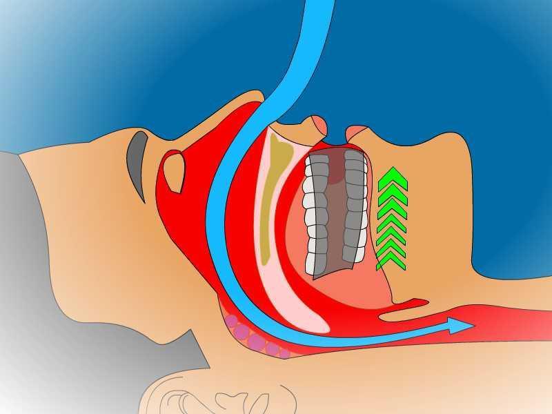 How the Oral Appliance Works Repositions the lower jaw, tongue, soft palate and
