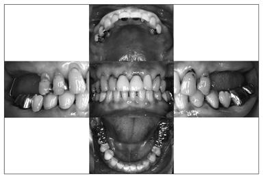 88 Sekine H et al. Fig. 2 Panoramic radiograph at first examination Fig. 1 Intra-oral view at first examination for such treatment 1).