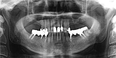 The sinus floor elevation technique, which allows implant installation by bone grafting, was devised for such cases 2), and this technique has recently been recognized as a predictable procedure 4,6).