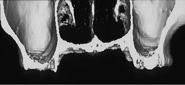 3 Preoperative CT photograph for diagnosis (a) Panoramic view (b) 3-D view of sinus (c)