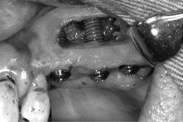 In the right upper molar region, implants were placed after bone grafting.