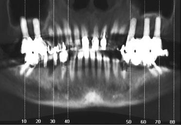 Screw-retained provisional restorations were inserted on both sides in October 2004, and the implants were functionally loaded.