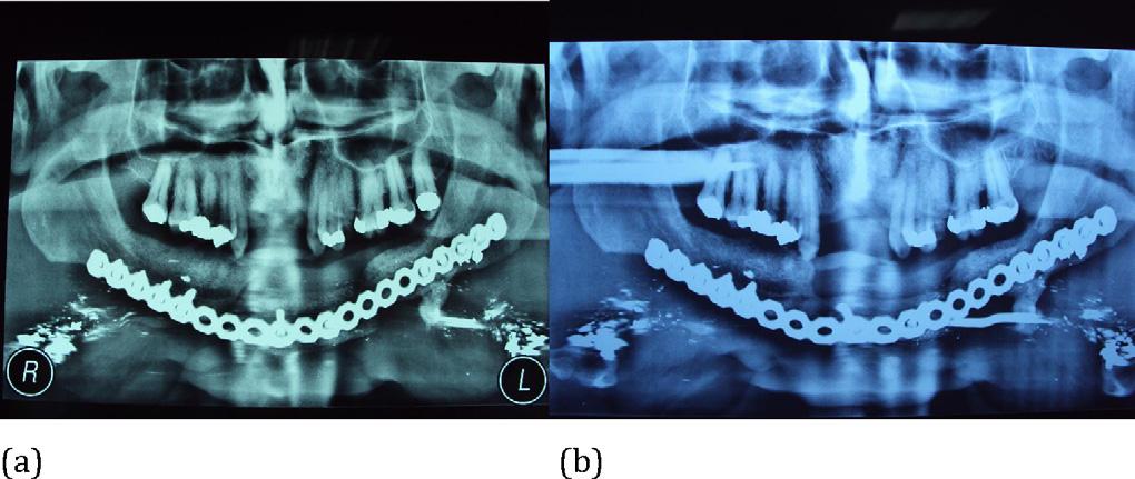 G. Guerrier et al. / British Journal of Oral and Maxillofacial Surgery xxx (2012) xxx xxx 3 Fig. 2.