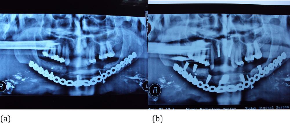 (a) Additional augmentation of the bone graft by a new graft harvested from the other side of the ilium. (b) Well-healed bone with rehabilitation of the mandible by dental implants.