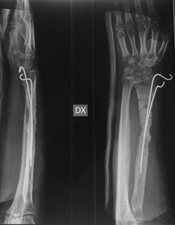 32 Ferdinando Da Rin De Lorenzo Figure 1: X-ray of the radius at the first visit. Case Report aspirate [BMA]/bone marrow concentrate [BMC]) to the graft [ 1 0 ].