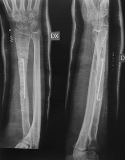 used in treating a recalcitrant, post-infective nonu n i o n o f a r a d i u s diaphyseal fracture. The 38-year-old male patient was in a car accident in January 2007 and fractured his right radius.