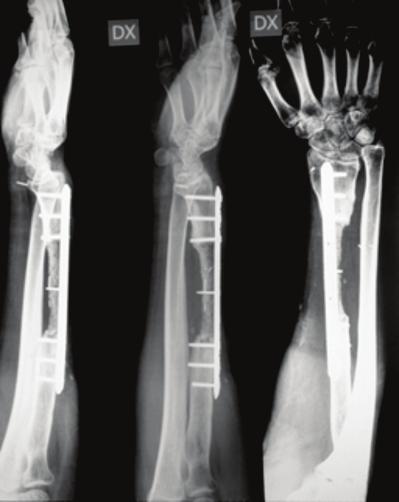 Figure 9: Control radiographs, taken 2 months after the grafting surgery, showed that the graft was still undergoing remodeling. infection.