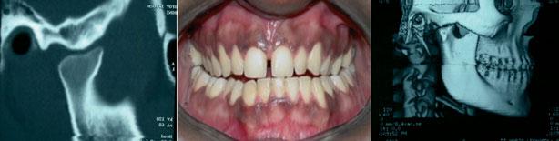 One or both TMJs can be involved in JIA, and the TMJ may even be the initial joint to be involved (107, 108).