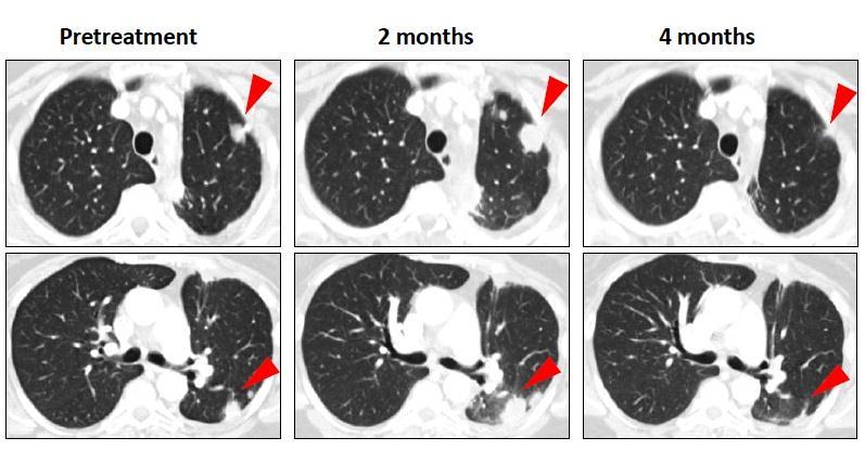Response of Metastatic NSCLC (BMS-936558, 10mg/kg) Initial progression in pulmonary lesions of a NSCLC patient with nonsquamous histology