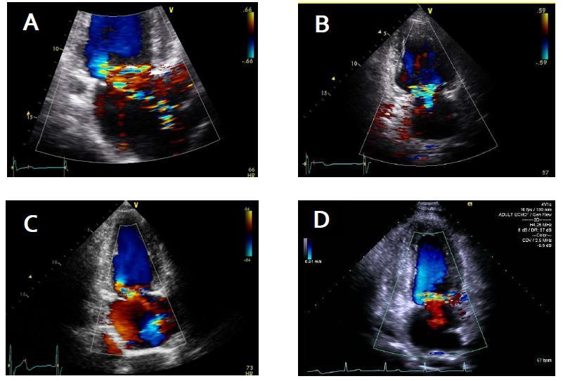 Results Representative examples of color Doppler flow patterns A: a V-shaped, double jet flow originating from posteromedial commissure B: a small V-shaped, double jet flow originating form