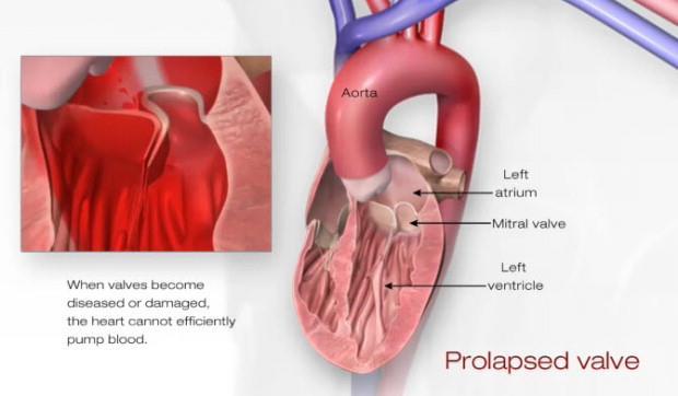 Introduction Mitral valve prolapse One of the main causes of MR
