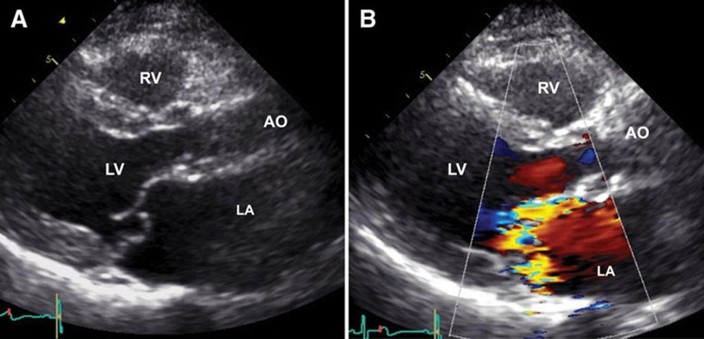 Introduction Transthoracic echocardiography in MV prolapse First line imaging modality for assessment of MR Localization and quantification of