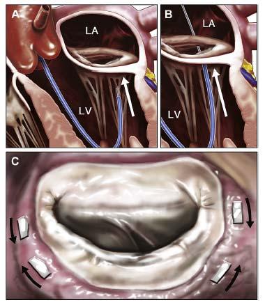 and ostial coronary sinus Reduces septal lateral annulus dimension