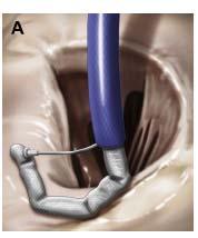 2011 Feldman and Young 2014, JACC Direct Mitral Annuloplasty