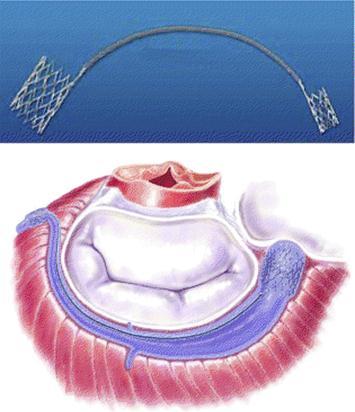 Beating-Heart Mitral Valve Repair Numerous devices in development Indirect annuloplasty via