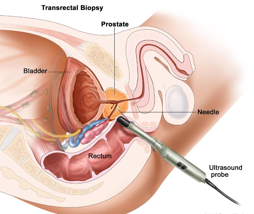 Facts About Prostate Biopsy Prostate Biopsy is Associated with Side Effects Difficulty urinating. In some men, procedure may cause difficulty while urinating.