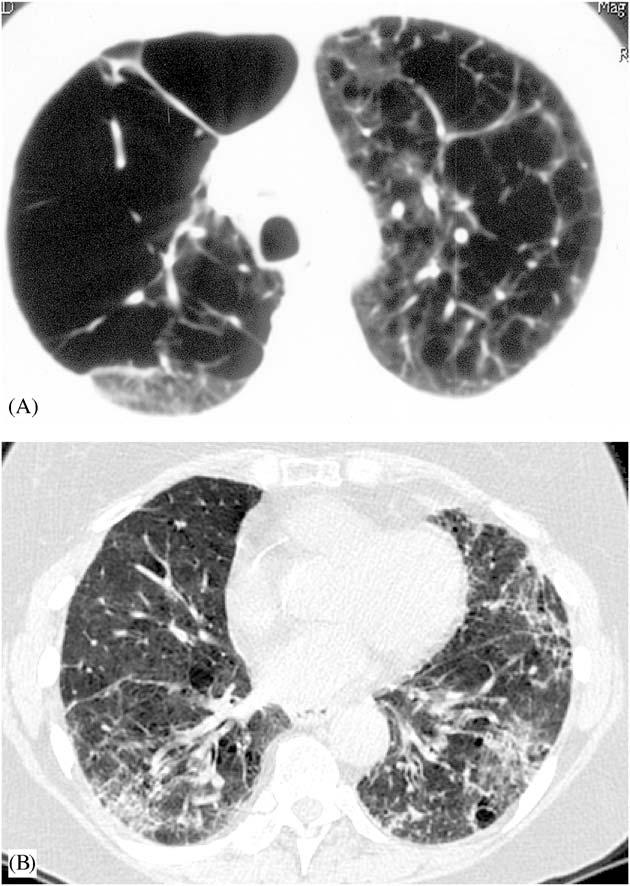 Hyperlucency of both upper lung zones combine with reticular pattern at the bases is seen. zones. In patients with respiratory bronchiolitisassociated interstitial pneumonia, high-resolution CT may show centrilobular nodules.