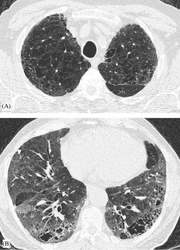 Pulmonary interstitial diseases 953 Figure 3 (A,B). CT section showing emphysema at the apices (A) and traction bronchiectasis, honeycombing as signs of fibrosis at the bases (B). Figure 4 (A,B).