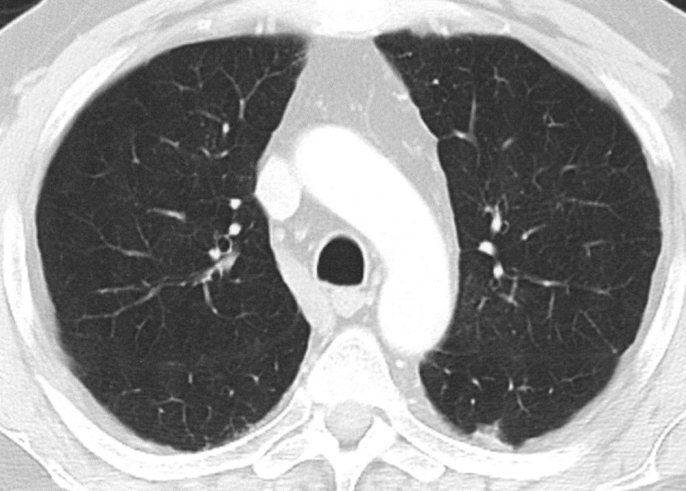 72-year-old woman who underwent double lung transplantation 5 years earlier because of chronic obstructive pulmonary disease.