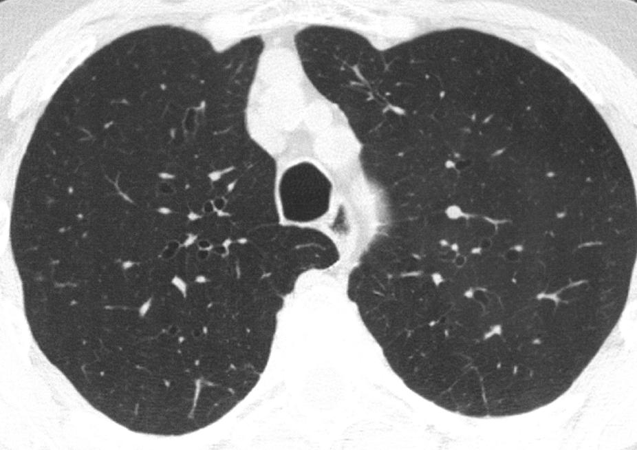38-year-old man who underwent double lung transplantation necessitated by end-stage sarcoidosis.
