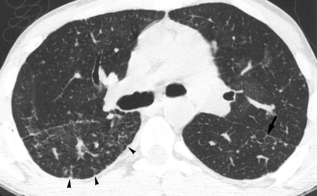 , xial high-resolution T scan obtained at level of carina 43 months after transplantation shows normal lung parenchyma.