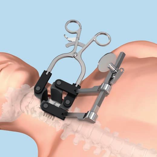 Exposure and Discectomy 1. Access Optional set 187.