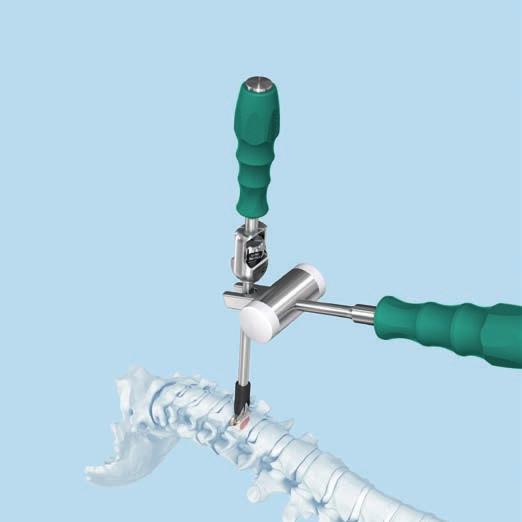 Tighten the knob clockwise until the implant has a rigid connection. Ensure that the implant is held flush against the insertion device and securely in the tabs.