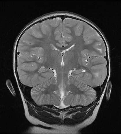 Patient 2: 5 year old male with tuberous sclerosis and multiple cortical tubers