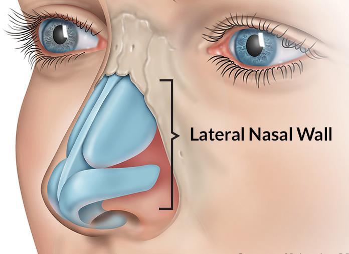 nasal valve valve