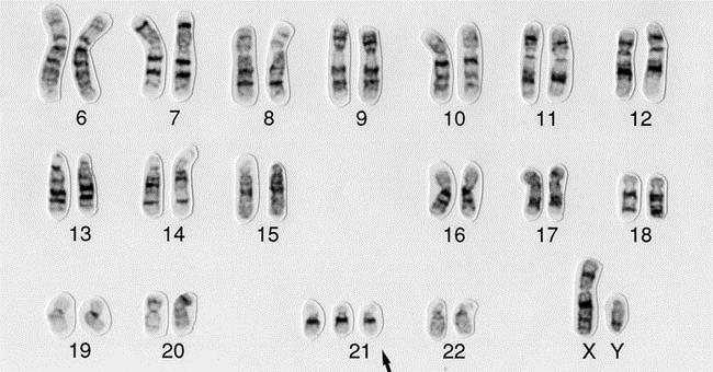 Down s Syndrome Karotype 3 chromosomes