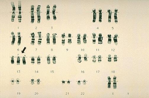 Patau s Syndrome Karotype 3 chromosomes