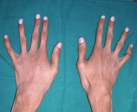Upper extremities showed long spidery fingers (arachnodactyly) with prominent finger joints [Figure 3]. The chest was flat with prominent ribs. Scoliosis and left kyphosis was also noticed.