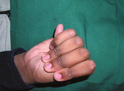 [3] Figure 9: Tall stature and long arm span Figure-10: Long spidery fingers (arachnodactyly) Figure 11: Deformed chest - pectus carinatum Later, the patient was referred to a physician for a