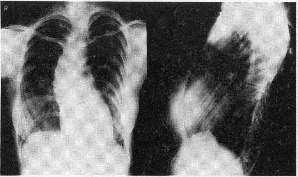 Comparison ofechocardiography and radiology in Marfan's syndrome and in syphilis mediastinum and no evidence of aortic dilatation.