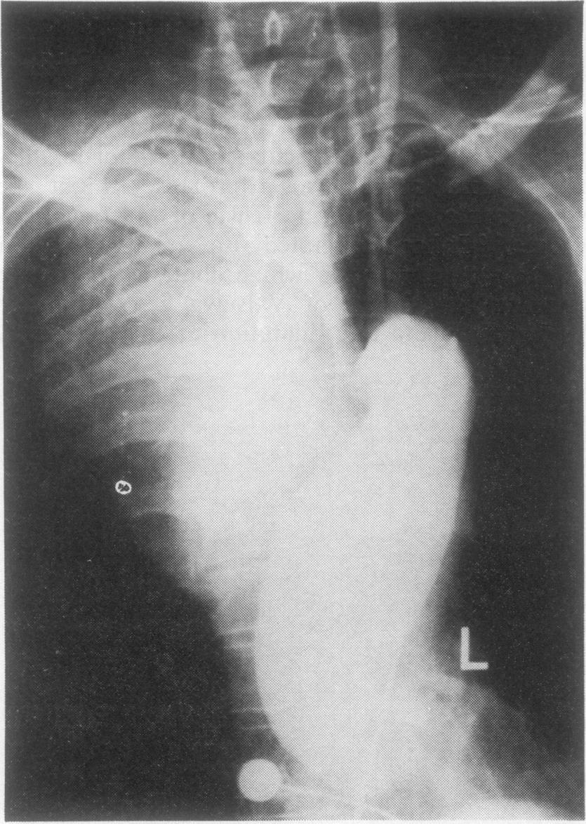 Aortogram showing fusiform dilation of the ascending aorta which is displaced to the left by a large aneurysm.